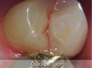 cracked tooth