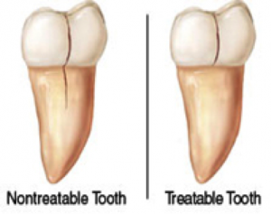 Cracked_tooth