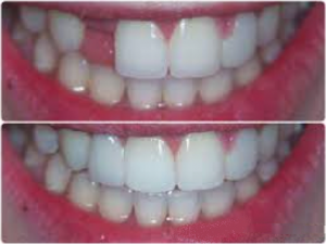 Fixed_bridges_Green_Square_dental