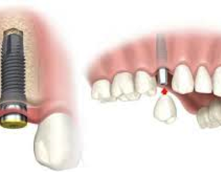 Dental Implants