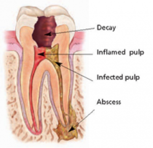 root canal