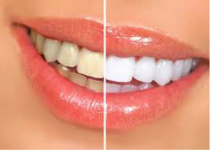 whitening