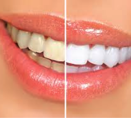 Tooth Whitening