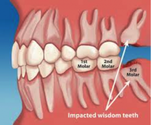 Wisdom_teeth_Green_Square_Dental