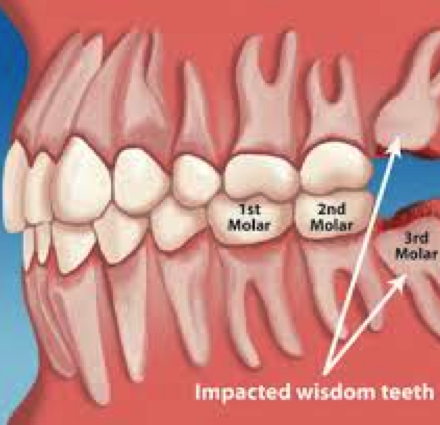 Wisdom teeth (Dental extractions)