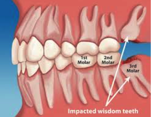 Wisdom teeth (Dental extractions)